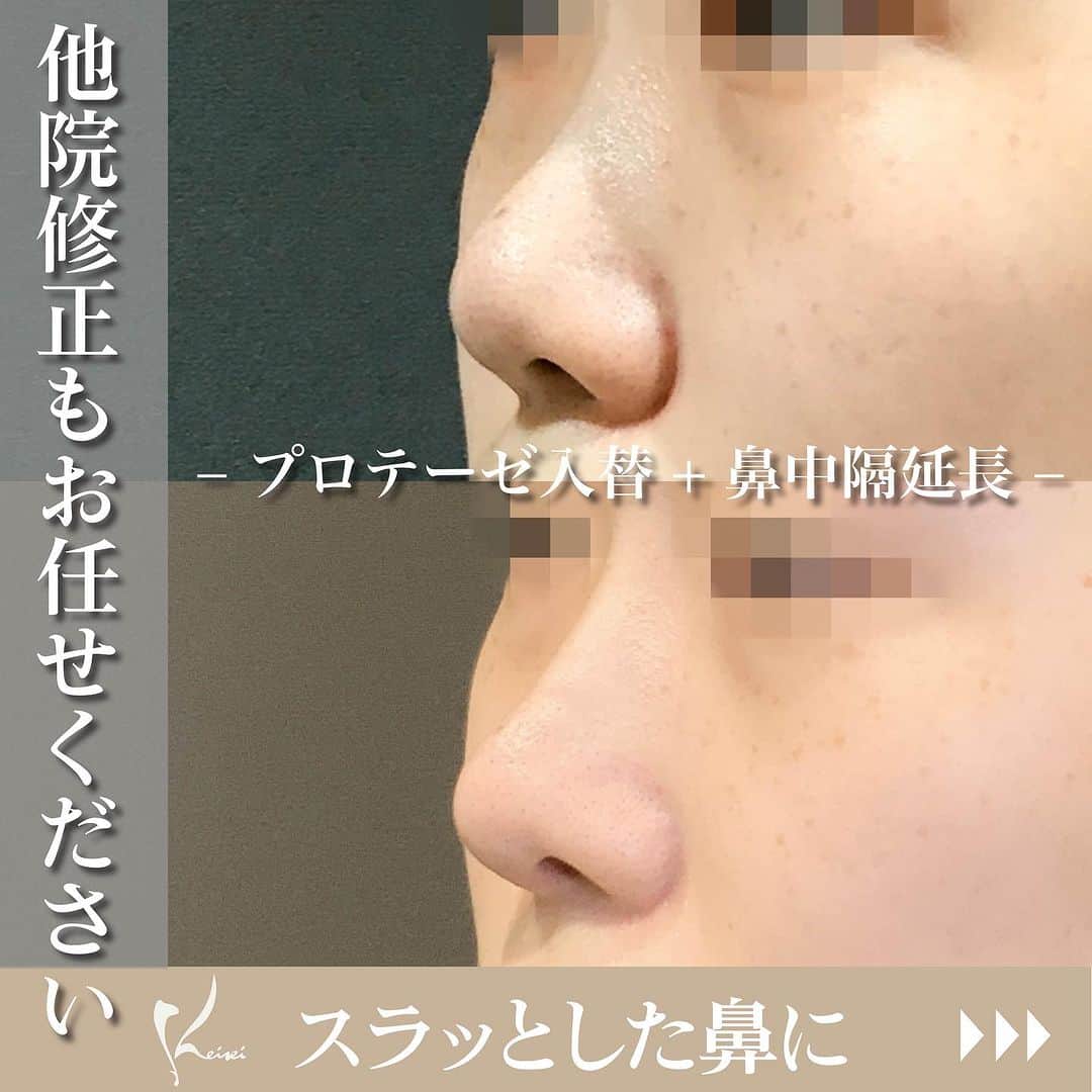 恵聖会クリニックのインスタグラム：「. ＼理想通りの鼻へ🧚🏻‍♀️🤍／  こちらは以前他院でプロテーゼと鼻尖形成をされたが もう少し鼻筋を高くして鼻先を細くして下げたいとご来院されたモニター様です💁🏻‍♀️  モニター様の理想に近づけるために、 ・プロテーゼを高いものに入れ替え ・助軟骨を移植し鼻中隔延長 の手術を行いました🫶🏻  術後1ヶ月でこの変化😳 ご本人にもご満足いただけました💖  当院ではお一人お一人に合った施術や方法をご提案いたします💁🏻‍♀️ 気になる方はぜひ無料カウンセリングへお越しください⭐️  🔖鼻プロテーぜ入れ替え（他院） 　¥230,000（税込 ¥253,000） 🔖鼻中隔延長(助軟骨移植) 　¥700,000（税込 ¥770,000） 🔖自家組織移植 　¥300,000（税込 ¥330,000）  【肋軟骨移植】 ※別途、麻酔代¥150,000（税込¥165,000）の他に、機械消耗品代などがかかる場合があります。  【リスク・副作用】 腫れ・浮腫・内出血・感染症・血腫 ※術後のフォローは、責任を持って行います。  執刀医：田川医師🧑‍⚕️  #鼻整形 #プロテーゼ #鼻中隔延長 #助軟骨移植 #団子鼻 #忘れ鼻 #横顔美人 #美容好き #美容医療 #美容クリニック #美容外科 #美容皮膚科 #美容整形外科 #大阪美容外科 #大阪美容皮膚科 #恵聖会クリニック」