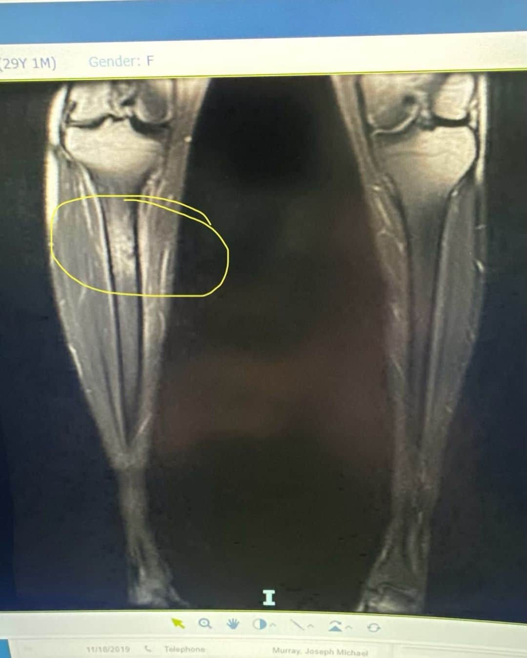 ブリアナ・コープさんのインスタグラム写真 - (ブリアナ・コープInstagram)「Miss new booty🫠😂🤦‍♀️ it’s honestly been really hard for me to process but turns out I fractured 85% of my tibia. I stayed in NYC to get a MRI after the marathon, because deep down i knew something was wrong. I felt like @davidgoggins during the marathon.. not so much after🤣😂😅 counting my blessing that I didn’t need surgery. Im someone who is in the water everyday surfing and this is the first time in my life not being able to surf.. I’ve been dealing with a lot of emotions because that’s my happy place🙏 for now it’s time to focus on recovery & rehab. Finding new activities like the peloton, swimming and cleaning my house🤣😅 I have such an amazing support crew keeping me positive. Onwards and upwards 🙂🤙🏽🙏 I’ll be back in the water in no time strong than ever 😉 swipe right to see how my recovery is going🤣」11月19日 10時25分 - briannacope