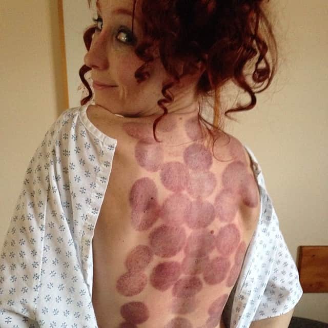ボニー・モーガンのインスタグラム：「Cupping at the chiropractor... I look like I tangled with an octopus 😝. Not sure who won that one! #suckerformassage #cuppedbyastranger #thissucks」