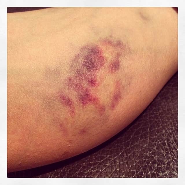真木よう子さんのインスタグラム写真 - (真木よう子Instagram)「自転車下り坂でテンション上がって、ふくらはぎ強打 なんか痛いと思ったらこのアザ もう上げません。テンションなんて」5月23日 22時43分 - yokomaki_official