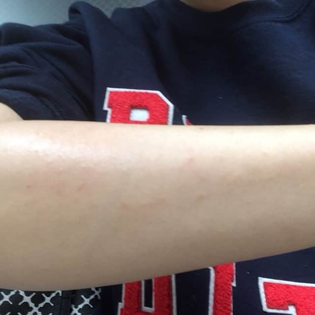 笛木優子さんのインスタグラム写真 - (笛木優子Instagram)「顔以外 蕁麻疹でました😱 痒い。。。 皆様もお気をつけて😭」2月6日 20時39分 - yukofuekiyumin